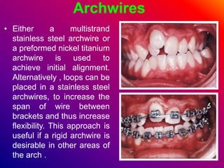 Archwires
• Either a multistrand
stainless steel archwire or
a preformed nickel titanium
archwire is used to
achieve initial alignment.
Alternatively , loops can be
placed in a stainless steel
archwires, to increase the
span of wire between
brackets and thus increase
flexibility. This approach is
useful if a rigid archwire is
desirable in other areas of
the arch .
 