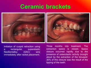Ceramic brackets
Initiation of cuspid retraction using
a rectangular, superelastic
NeoSentalloy (GAC) wire
immediately after racket placement.
Three months into treatment. The
extraction space is closed. Space
closure occurred rapidly due to the
presence of osteoclastic activity brought
about by the extraction of the bicuspid:
30% of this closure was the result of the
tipping of the teeth.
 