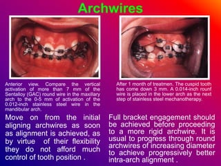 Archwires
Anterior view. Compare the vertical
activation of more than 7 mm of the
Sentalloy (GAC) round wire in the maxillary
arch to the 0-5 mm of activation of the
0.012-inch stainless steel wire in the
mandibular arch.
Move on from the initial
aligning archwires as soon
as alignment is achieved, as
by virtue of their flexibility
they do not afford much
control of tooth position .
After 1 month of treatmen. The cuspid tooth
has come down 3 mm. A 0.014-inch rounf
wire is placed in the lower arch as the next
step of stainless steel mechanotherapy.
Full bracket engagement should
be achieved before proceeding
to a more rigid archwire. It is
usual to progress through round
archwires of increasing diameter
to achieve progressively better
intra-arch alignment .
 