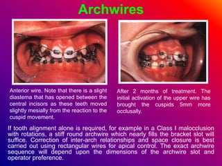Archwires
If tooth alignment alone is required, for example in a Class I malocclusion
with rotations, a stiff round archwire which nearly fills the bracket slot will
suffice. Correction of inter-arch relationships and space closure is best
carried out using rectangular wires for apical control. The exact archwire
sequence will depend upon the dimensions of the archwire slot and
operator preference.
Anterior wire. Note that there is a slight
diastema that has opened between the
central incisors as these teeth moved
slightly mesially from the reaction to the
cuspid movement.
After 2 months of treatment. The
initial activation of the upper wire has
brought the cuspids 5mm more
occlusally.
 