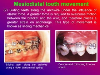 Mesiodistal tooth movement
(2) Sliding teeth along the archwire under the influence of
elastic force. A greater force is required to overcome friction
between the bracket and the wire, and therefore places a
greater strain on anchorage. This type of movement is
known as sliding mechanics .
Sliding teeth along the archwire
using a nickel titanium coil spring.
Compressed coil spring to open
space.
 