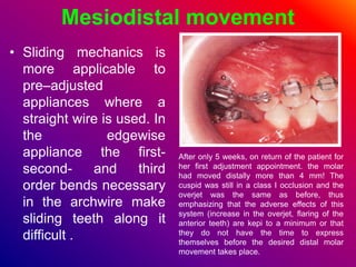 Mesiodistal movement
• Sliding mechanics is
more applicable to
pre–adjusted
appliances where a
straight wire is used. In
the edgewise
appliance the first-
second- and third
order bends necessary
in the archwire make
sliding teeth along it
difficult .
After only 5 weeks, on return of the patient for
her first adjustment appointment. the molar
had moved distally more than 4 mm! The
cuspid was still in a class I occlusion and the
overjet was the same as before, thus
emphasizing that the adverse effects of this
system (increase in the overjet, flaring of the
anterior teeth) are kepi to a minimum or that
they do not have the time to express
themselves before the desired distal molar
movement takes place.
 