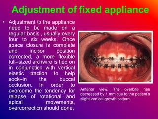 Adjustment of fixed appliance
• Adjustment to the appliance
need to be made on a
regular basis , usually every
four to six weeks. Once
space closure is complete
and incisor position
corrected, a more flexible
full–sized archwire is tied on
in conjunction with vertical
elastic traction to help
sock–in the buccal
occlusion. In order to
overcome the tendency for
relapse of rotational and
apical movements,
overcorrection should done.
Anterior view. The overbite has
decreased by 1 mm due to the patient’s
slight vertical growth pattern.
 