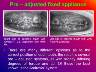 Pre – adjusted fixed appliance
• There are many different opinions as to the
correct position of each tooth, the result is several
pre – adjusted systems, all with slightly differing
degrees of torque and tip. Of these the best
known is the Andrews’ system.
Right side of patient’s mouth with
Ormco/”A” Co. appliance with Roth
Rx.
Left side of patient’s mouth with GAC
Roth Rx appliance.
 
