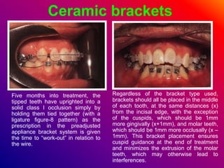 Ceramic brackets
Five months into treatment, the
tipped teeth have uprighted into a
solid class I occlusion simply by
holding them tied together (with a
ligature figure-8 pattern) as the
prescription in the preadjusted
appliance bracket system is given
the time to “work-out” in relation to
the wire.
Regardless of the bracket type used,
brackets should all be placed in the middle
of each tooth, at the same distances (x)
from the incisal edge, with the exception
of the cuspids, which should be 1mm
more gingivally (x+1mm), and molar teeth,
which should be 1mm more occlusally (x –
1mm). This bracket placement ensures
cuspid guidance at the end of treatment
and minimizes the extrusion of the molar
teeth, which may otherwise lead to
interferences.
 