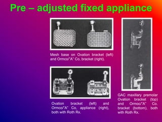 Pre – adjusted fixed appliance
Mesh base on Ovation bracket (left)
and Ormco/”A” Co, bracket (right).
Ovation bracket (left) and
Ormco/”A” Co, appliance (right),
both with Roth Rx.
GAC maxillary premolar
Ovation bracket (top)
and Ormoc/”A” Co.
bracket (bottom), both
with Roth Rx.
 