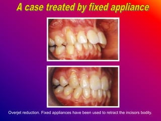 Overjet reduction. Fixed appliances have been used to retract the incisors bodily.
 