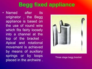 Begg fixed appliance
• Named after its
originator , the Begg
appliance is based on
the use of round wire
which fits fairly loosely
into a channel at the
top of the bracket .
Apical and rotational
movement is achieved
by means of auxiliary
springs or by loops
placed in the archwire .
Three stage begg bracket
 