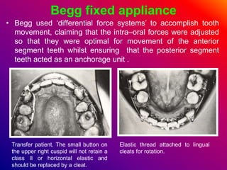 Begg fixed appliance
• Begg used ‘differential force systems’ to accomplish tooth
movement, claiming that the intra–oral forces were adjusted
so that they were optimal for movement of the anterior
segment teeth whilst ensuring that the posterior segment
teeth acted as an anchorage unit .
Transfer patient. The small button on
the upper right cuspid will not retain a
class II or horizontal elastic and
should be replaced by a cleat.
Elastic thread attached to lingual
cleats for rotation.
 