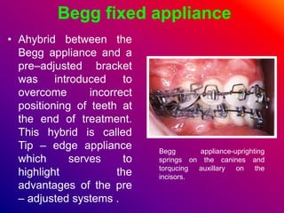 Begg fixed appliance
• Ahybrid between the
Begg appliance and a
pre–adjusted bracket
was introduced to
overcome incorrect
positioning of teeth at
the end of treatment.
This hybrid is called
Tip – edge appliance
which serves to
highlight the
advantages of the pre
– adjusted systems .
Begg appliance-uprighting
springs on the canines and
torqucing auxillary on the
incisors.
 