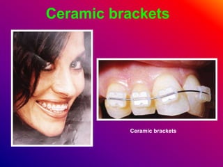 Ceramic brackets
Ceramic brackets
 
