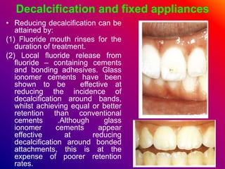 Decalcification and fixed appliances
• Reducing decalcification can be
attained by:
(1) Fluoride mouth rinses for the
duration of treatment.
(2) Local fluoride release from
fluoride – containing cements
and bonding adhesives. Glass
ionomer cements have been
shown to be effective at
reducing the incidence of
decalcification around bands,
whilst achieving equal or better
retention than conventional
cements .Although glass
ionomer cements appear
effective at reducing
decalcification around bonded
attachments, this is at the
expense of poorer retention
rates.
 
