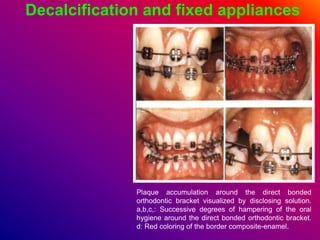 Decalcification and fixed appliances
Plaque accumulation around the direct bonded
orthodontic bracket visualized by disclosing solution.
a,b,c,: Successive degrees of hampering of the oral
hygiene around the direct bonded orthodontic bracket.
d: Red coloring of the border composite-enamel.
 