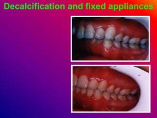 Decalcification and fixed appliances
 