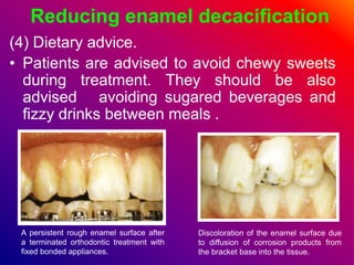 Reducing enamel decacification
(4) Dietary advice.
• Patients are advised to avoid chewy sweets
during treatment. They should be also
advised avoiding sugared beverages and
fizzy drinks between meals .
A persistent rough enamel surface after
a terminated orthodontic treatment with
fixed bonded appliances.
Discoloration of the enamel surface due
to diffusion of corrosion products from
the bracket base into the tissue.
 