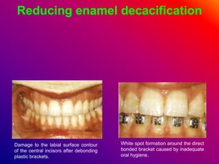 Reducing enamel decacification
Damage to the labial surface contour
of the central incisors after debonding
plastic brackets.
White spot formation around the direct
bonded bracket caused by inadequate
oral hygiene.
 