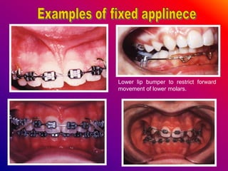 Lower lip bumper to restrict forward
movement of lower molars.
 