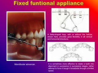 Mandibular advancer. It is sometimes more effective to rotate a tooth into
alignment in successive in successive stages, rather
attempt to force it bough it broadside through a limited
space.
A delta-shaped loop, with or without the helices
shown here, provides good flexibility in all vertical
and horizontal directions.
 