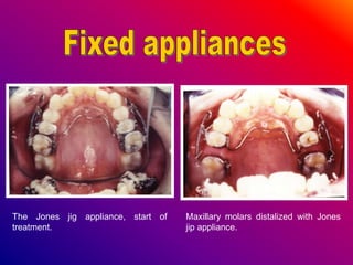 The Jones jig appliance, start of
treatment.
Maxillary molars distalized with Jones
jip appliance.
 