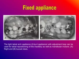 The light labial arch appliance (2-by-4 appliance) with adjustment loop can be
used for labial repositioning of the maxillary as well as mandibular incisors. (A)
Right and (B) buccal views.
 