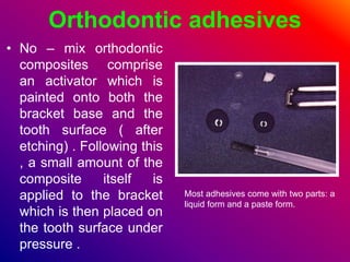 Orthodontic adhesives
• No – mix orthodontic
composites comprise
an activator which is
painted onto both the
bracket base ...