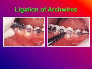 Ligation of Archwires
 