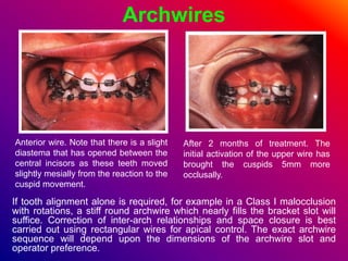 Archwires
If tooth alignment alone is required, for example in a Class I malocclusion
with rotations, a stiff round archwi...