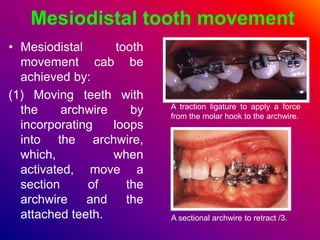 Mesiodistal tooth movement
• Mesiodistal tooth
movement cab be
achieved by:
(1) Moving teeth with
the archwire by
incorpor...