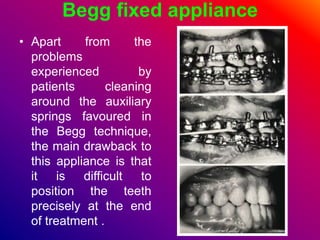 Begg fixed appliance
• Ahybrid between the
Begg appliance and a
pre–adjusted bracket
was introduced to
overcome incorrect
...