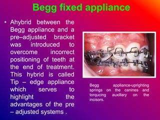 Decalcification and fixed appliances
• Placement of a fixed
appliance upon a tooth
surface leads to plaque
accumulation. I...