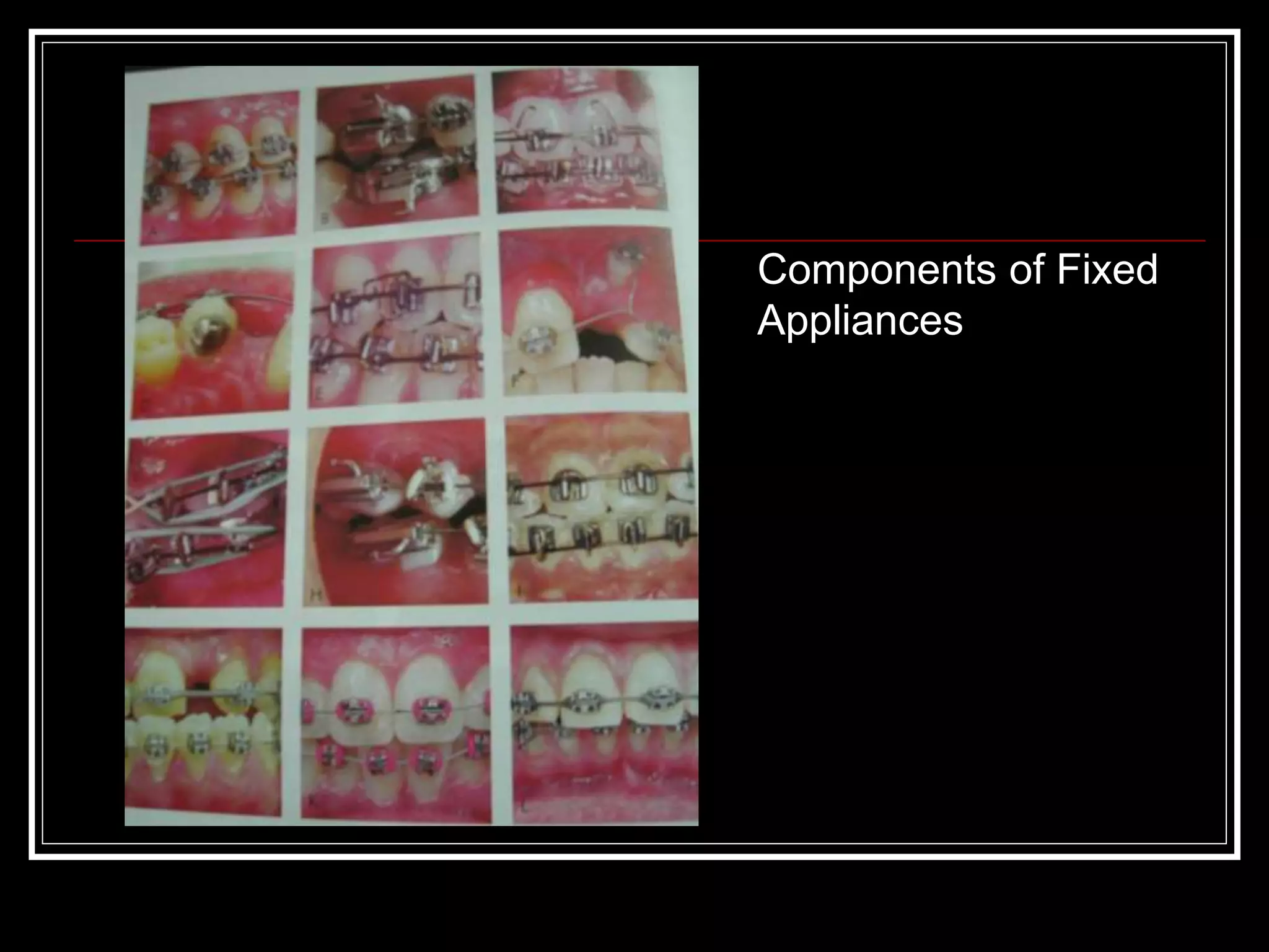 Fixed Appliance O.ppt