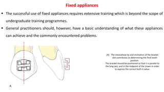  The successful use of fixed appliances requires extensive training which is beyond the scope of
undergraduate training programmes.
 General practitioners should, however, have a basic understanding of what these appliances
can achieve and the commonly encountered problems.
Fixed appliances
(A) The mesiodistal tip and inclination of the bracket
slot contributes to determining the final tooth
position.
The bracket should be positioned so that it is parallel to
the long axis, and in the midpoint of the crown in order
to express the correct built-in value.
 