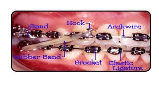 Comprehensive Overview of Fixed Orthodontic Appliances: Components ...
