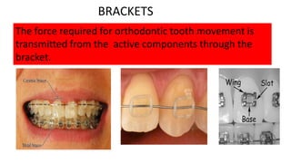 BRACKETS
The force required for orthodontic tooth movement is
transmitted from the active components through the
bracket.

 