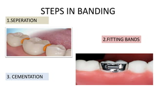 STEPS IN BANDING
1.SEPERATION

2.FITTING BANDS

3. CEMENTATION

 