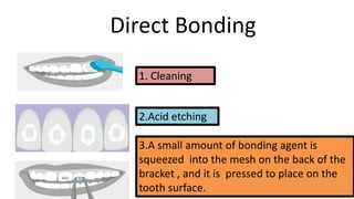 Direct Bonding
1. Cleaning
2.Acid etching
3.A small amount of bonding agent is
squeezed into the mesh on the back of the
bracket , and it is pressed to place on the
tooth surface.

 