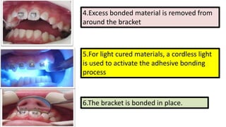 4.Excess bonded material is removed from
around the bracket

5.For light cured materials, a cordless light
is used to activate the adhesive bonding
process

6.The bracket is bonded in place.

 