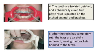 4. The teeth are isolated , etched,
and a chemically cured two
paste resin is painted on the
etched enamel and brackets.

5. After the resin has completely
set , the trays are carefully
removed , leaving the brackets
bonded to the teeth.

 
