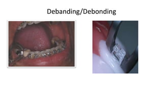 Debanding/Debonding

 