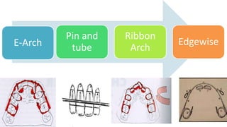 E-Arch

Pin and
tube

Ribbon
Arch

Edgewise

 