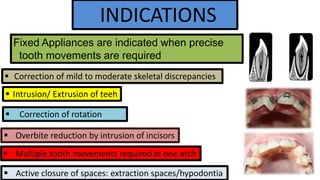 INDICATIONS
Fixed Appliances are indicated when precise
tooth movements are required
 Correction of mild to moderate skeletal discrepancies
 Intrusion/ Extrusion of teeh


Correction of rotation

 Overbite reduction by intrusion of incisors

 Multiple tooth movements required in one arch
 Active closure of spaces: extraction spaces/hypodontia

 