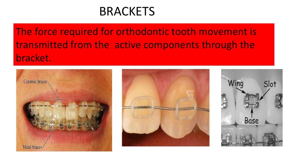 Fixed appliances in orthodontics