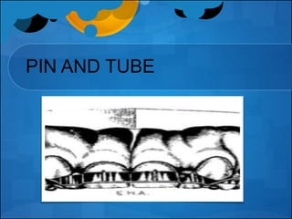 Pin Tube Tooth Fixed orthodontic appliances | PPTX