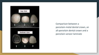 Comparison between a
porcelain-metal dental crown, an
all-porcelain dental crown and a
porcelain veneer laminate
 