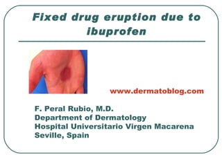 Fixed drug eruption due to ibuprofen www.dermatoblog.com F. Peral Rubio, M.D. Department of Dermatology Hospital Universitario Virgen Macarena Seville, Spain 