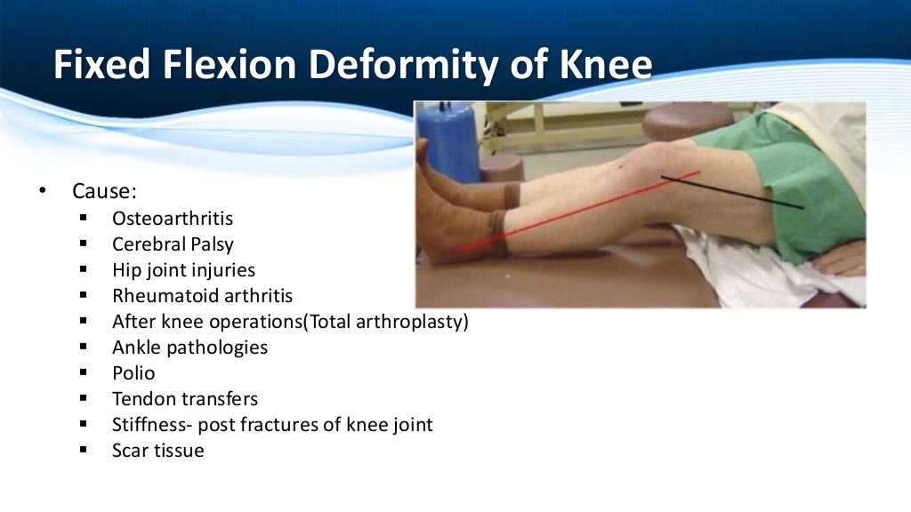 Fixed Flexion Deformity