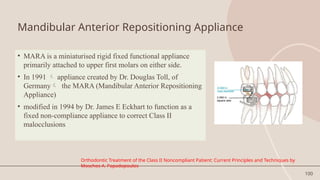 100
Mandibular Anterior Repositioning Appliance
• MARA is a miniaturised rigid fixed functional appliance
primarily attached to upper first molars on either side.
• In 1991  appliance created by Dr. Douglas Toll, of
Germany the MARA (Mandibular Anterior Repositioning
Appliance)
• modified in 1994 by Dr. James E Eckhart to function as a
fixed non-compliance appliance to correct Class II
malocclusions
Orthodontic Treatment of the Class II Noncompliant Patient: Current Principles and Techniques by
Moschos A. Papadopoulos
 