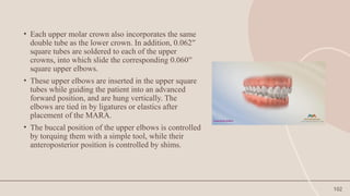 102
• Each upper molar crown also incorporates the same
double tube as the lower crown. In addition, 0.062′′
square tubes are soldered to each of the upper
crowns, into which slide the corresponding 0.060′′
square upper elbows.
• These upper elbows are inserted in the upper square
tubes while guiding the patient into an advanced
forward position, and are hung vertically. The
elbows are tied in by ligatures or elastics after
placement of the MARA.
• The buccal position of the upper elbows is controlled
by torquing them with a simple tool, while their
anteroposterior position is controlled by shims.
 