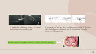 112
5. Mandibular rod inserted through “O” loop of
archwire and manipulated upward.
6. Annealed .036" pin bent down mesial to headgear tube. B. Maxillary
tube attached mesial to headgear tube. C. Annealed pin inserted at
mesial end of headgear tube
Class II patient with MPA No. 3 in place, showing maximum opening
 