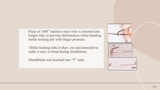 115
Piece of .040" stainless steel wire is inserted into
longer tube to prevent deformation while bending
molar locking pin with finger pressure.
Molar locking tube is then cut and annealed to
make it easy to bend during installation.
Mandibular rod inserted into “T” tube.
 